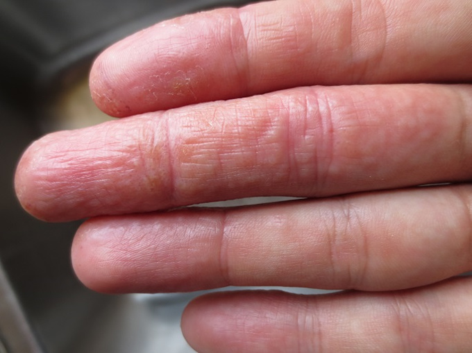 Red spots on hand and feet that itch - DoctorSpring